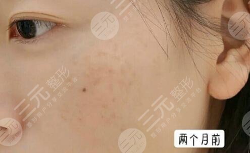 上海第一人民醫(yī)院祛斑案例分享
