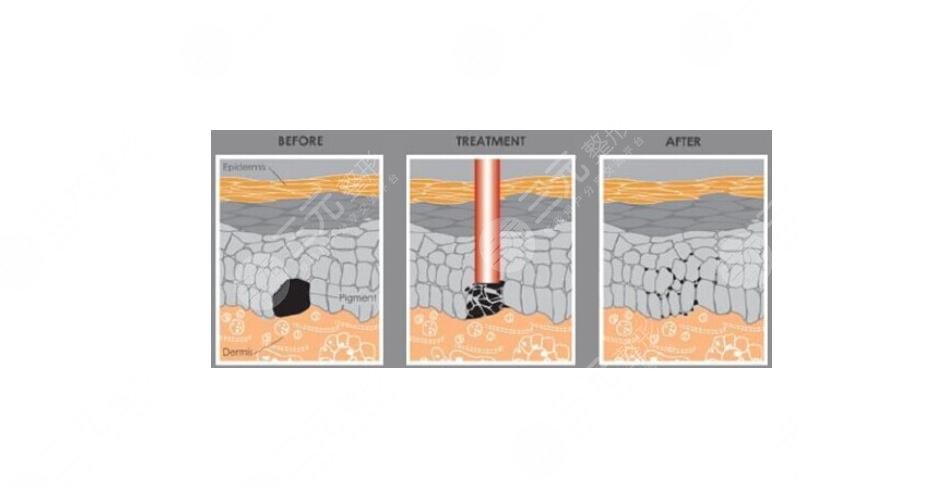 陳立彬?醫(yī)生做疤痕疙瘩的手術怎么樣?