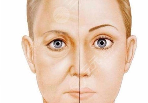 脂肪填充淚溝5到10天照片案例分享來啦