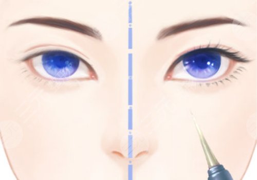 昆明李韜雙眼皮案例