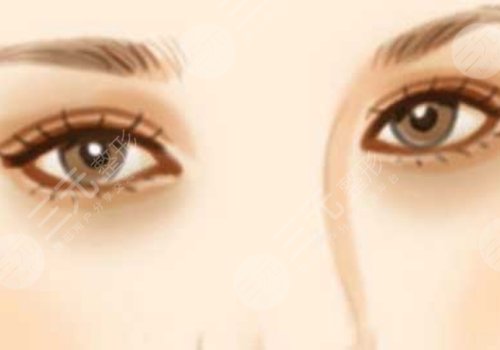 莊蔚強(qiáng)醫(yī)生雙眼皮案例