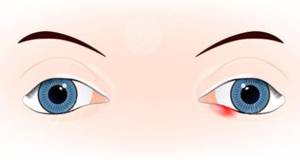 雙眼皮修復(fù)