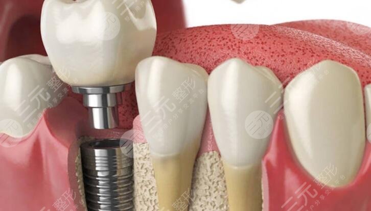 上海國(guó)際醫(yī)學(xué)中心種牙案例參考