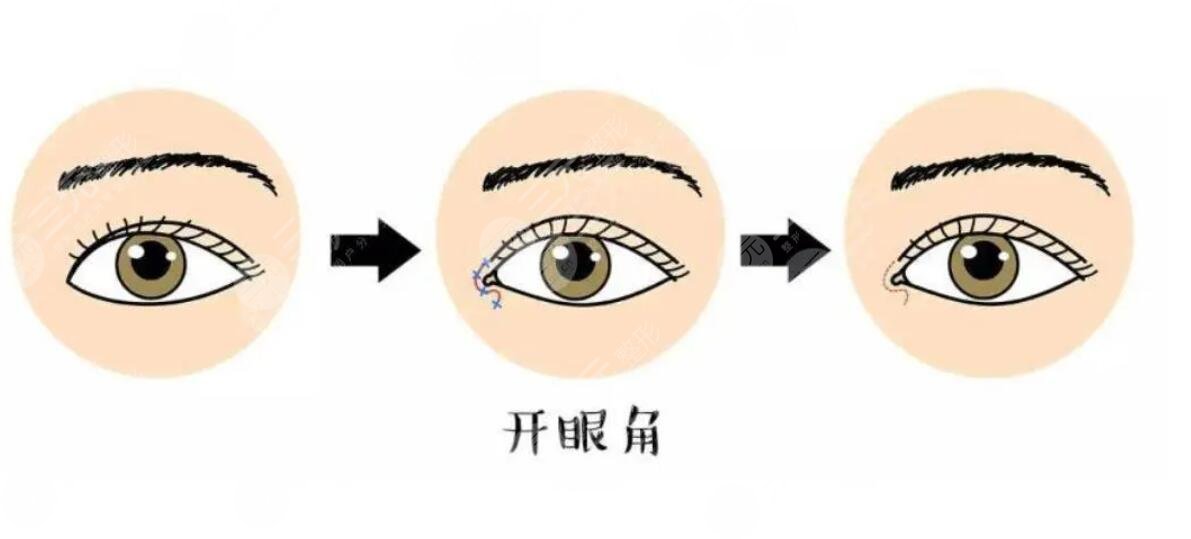 開(kāi)眼角