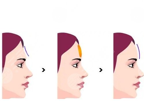 額頭填充膠原蛋白多久恢復正常