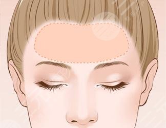 額頭填充膠原蛋白多久恢復正常