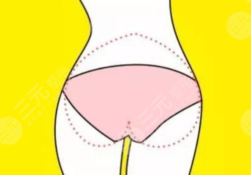 填充臀部一般多少錢