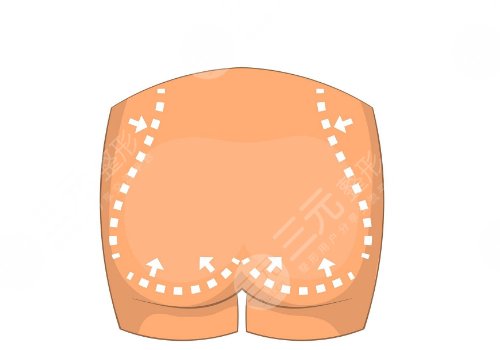 填充臀部一般多少錢