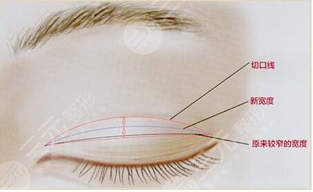 北京韓勛眼修復(fù)案例分享