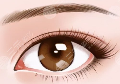 梁奕敏雙眼皮修復案例