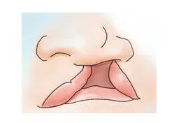 范鍇醫(yī)生做唇裂二次修復(fù)怎么樣啊?