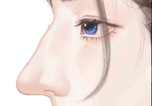 鼻修復(fù)是取出來直接做嗎