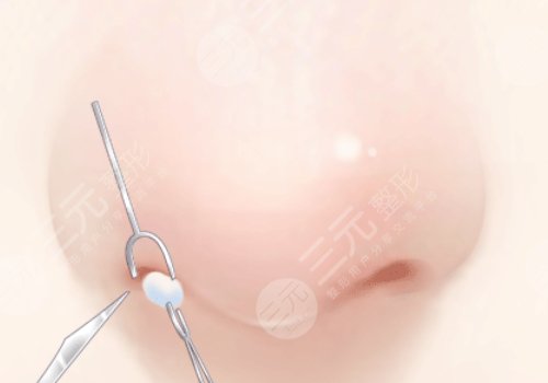 鼻修復(fù)是取出來直接做嗎