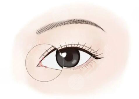 陸軍總醫(yī)院美容中心開(kāi)眼角科普知識(shí)分享