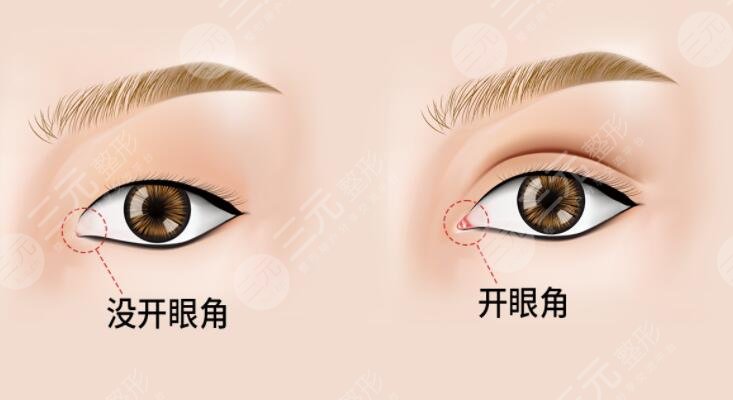 陸軍總醫(yī)院美容中心開(kāi)眼角科普知識(shí)分享