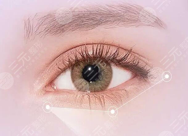 沈陽葉薇薇雙眼皮怎么樣