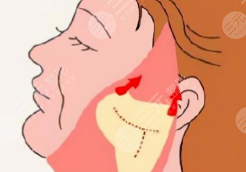 微創(chuàng)小切口拉皮恢復(fù)期多長時(shí)間