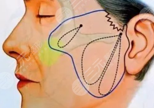 微創(chuàng)小切口拉皮恢復(fù)期多長時(shí)間