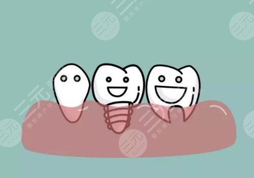 種植牙的過程步驟