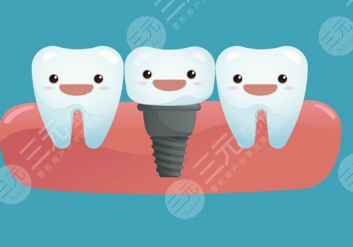 種植牙的過程步驟