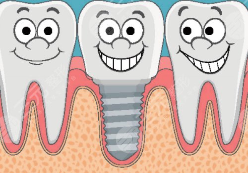 種植牙的過程步驟