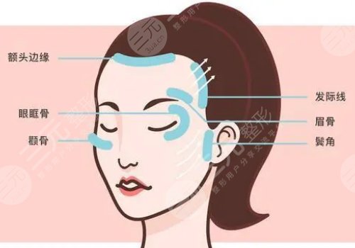 小拉皮手術(shù)可以維持多久