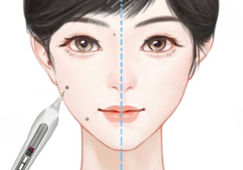 南京藝星醫(yī)療美容醫(yī)院祛痣多少錢