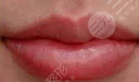 張曼醫(yī)生做唇排名第幾？醫(yī)生特點介紹，唇部整形案例來襲！