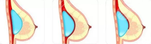 歐陽天祥醫(yī)生隆胸案例