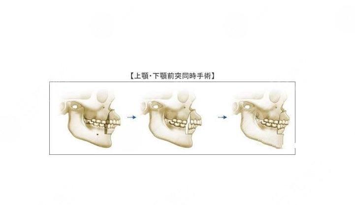 科普頜面畸形的調(diào)整過程，重塑臉型!