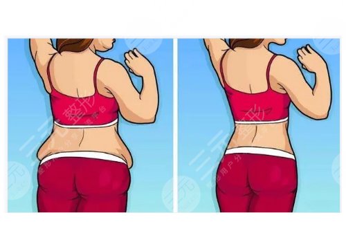 水動(dòng)力吸脂多少錢一部位