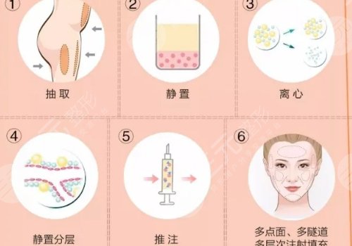 填充面部整形要多少錢(qián)