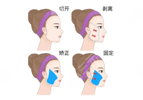 拉皮手術(shù)能維持幾年