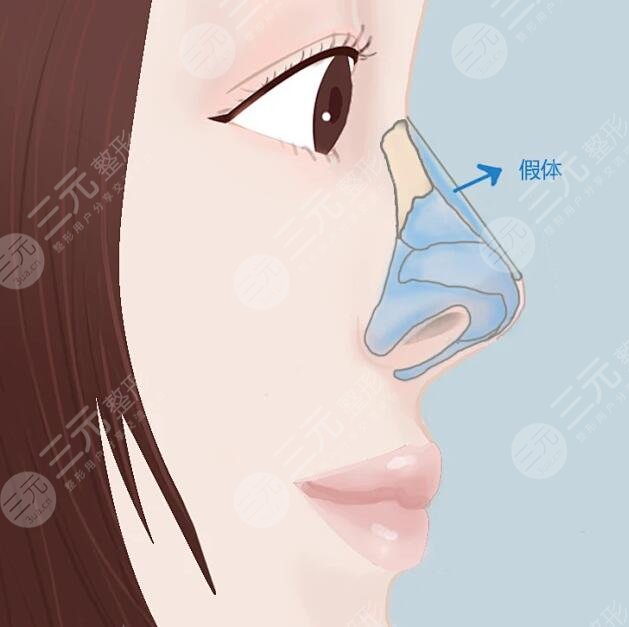 胡斌醫(yī)生做鼻子的技術(shù)特點