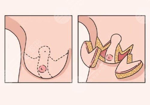 縮胸手術(shù)真實案例前后對比圖案例分享