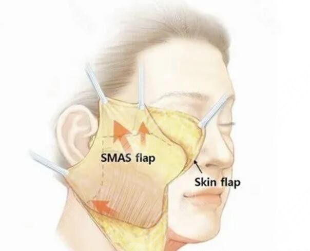 psv面部提升和拉皮的相同點(diǎn)