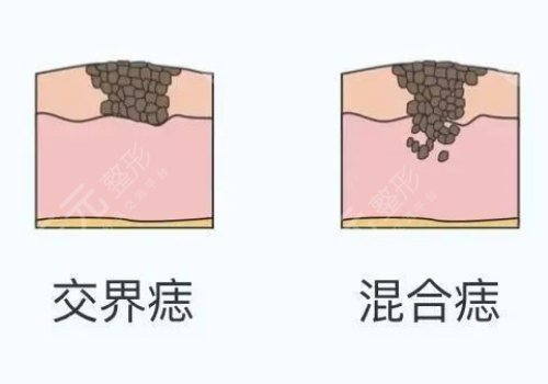 臧夢(mèng)青案例