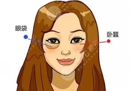 柳曉杰割眼袋怎么樣