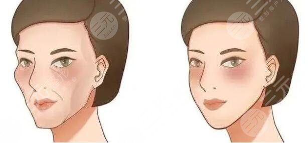 劉文先醫(yī)生玻尿酸注射填充太陽(yáng)穴案例