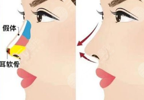 上海第九醫(yī)院隆鼻前后對(duì)比