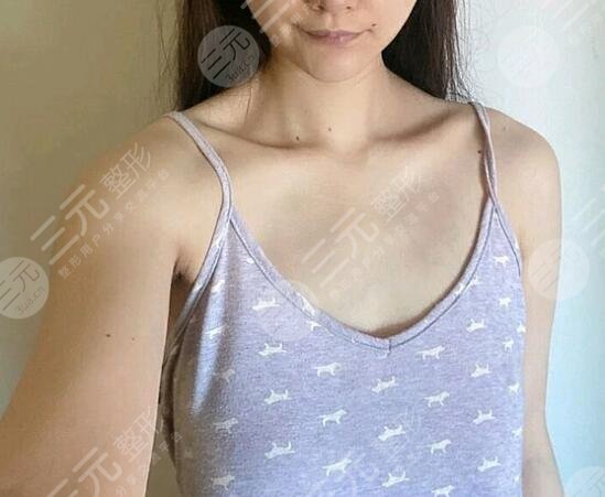 水滴型假體隆胸前后對比效果圖片和手術過程分享，小白隆胸避坑！