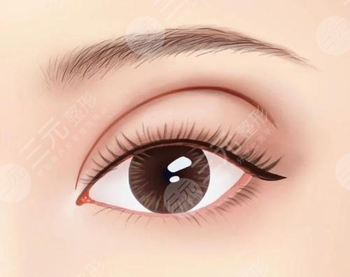 青島王志國(guó)醫(yī)生雙眼皮案例反饋