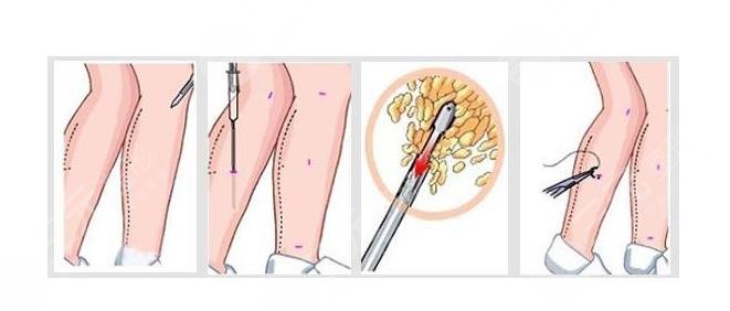 北京孫波醫(yī)生吸脂瘦小腿案例