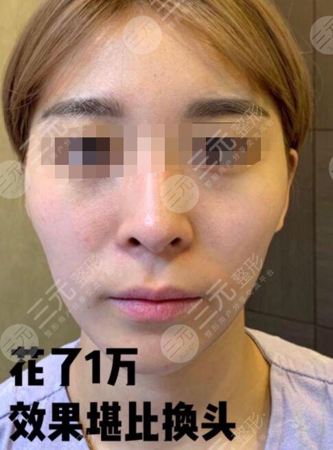 自體脂肪豐額頭親身經(jīng)歷講述