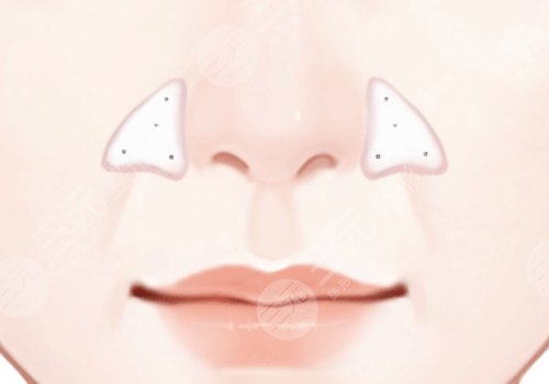 上海九院墊鼻基底費(fèi)用