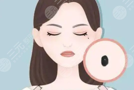 上海同濟(jì)醫(yī)院激光去痣案例