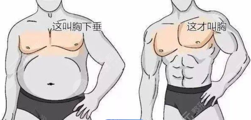 男生脂肪胸