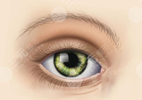 敖健飛修復(fù)雙眼皮嗎