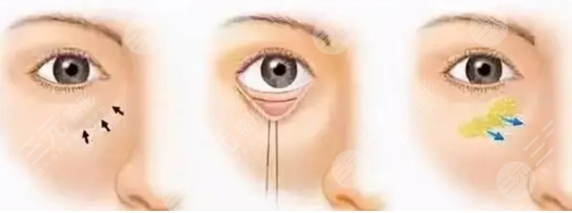 重慶西南醫(yī)院做眼袋手術(shù)案例