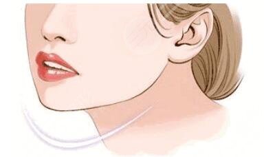 廣州下頜角截骨手術(shù)多少錢